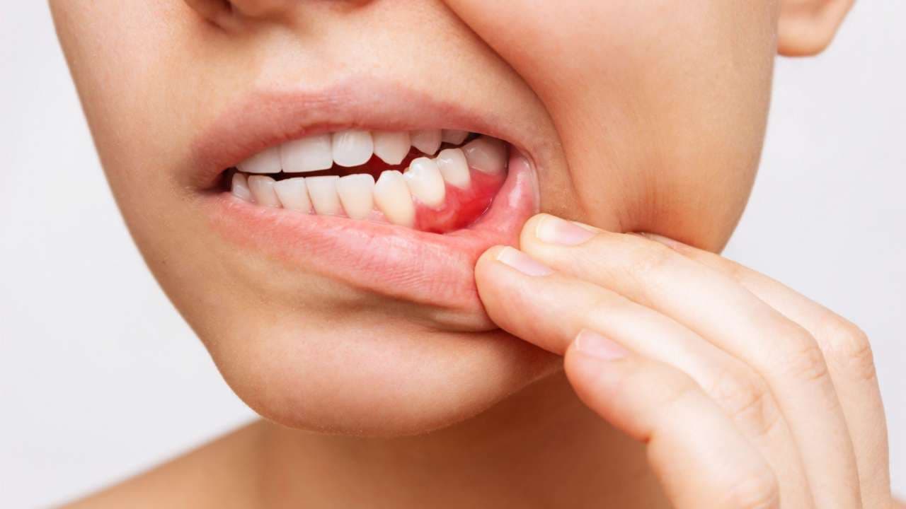 What Causes Bleeding Gums?