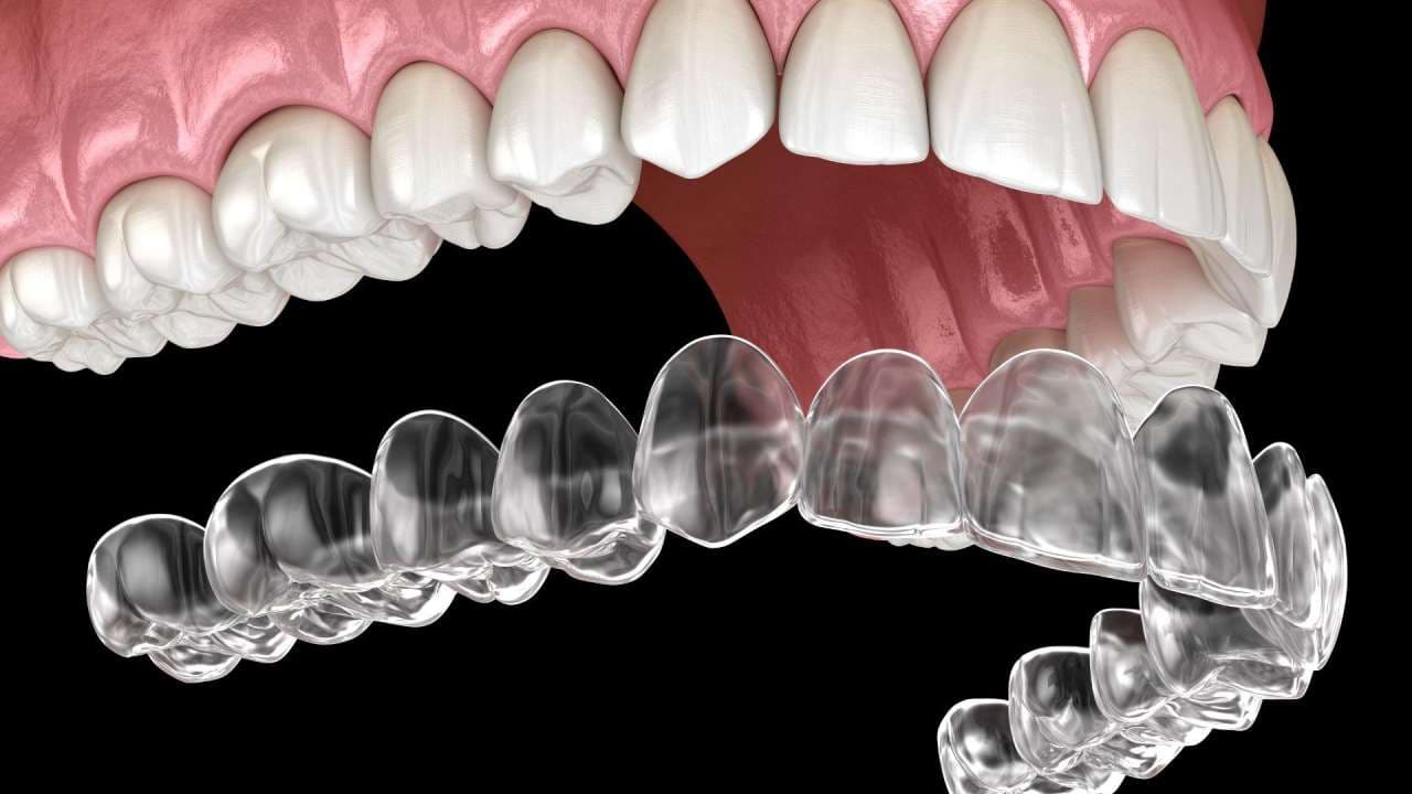 Veneers versus clear aligners: which is better?