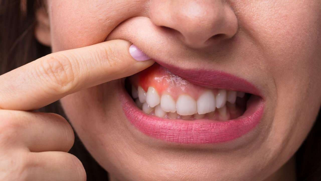 Gummy Smile : Causes and Treatment