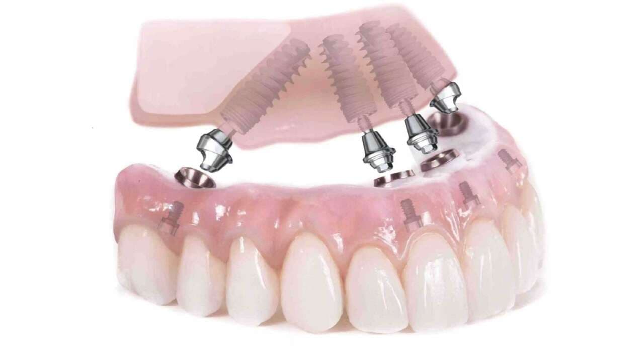 All On 4 Plus® Dental Implants