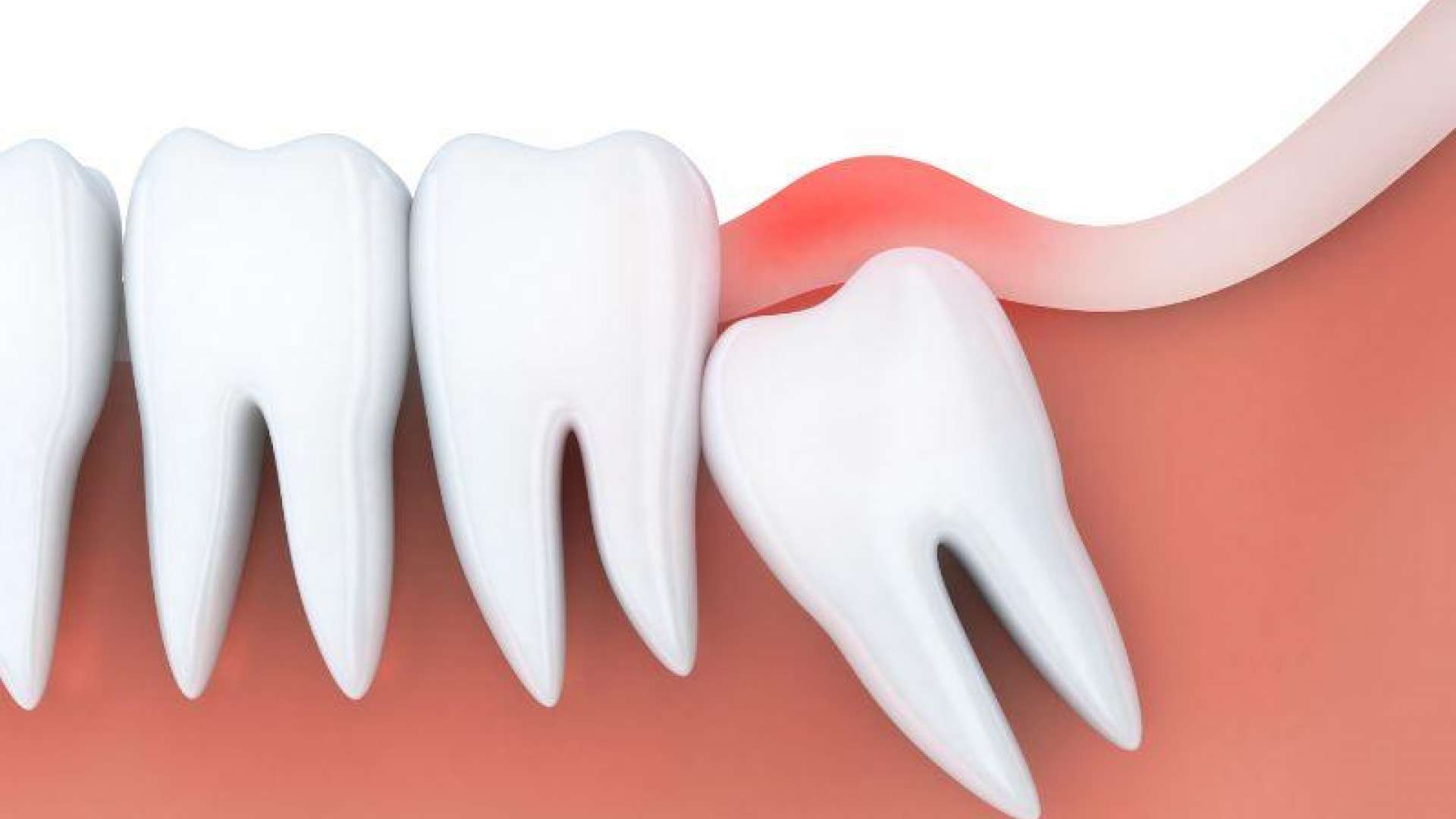 Wisdom Tooth Removal - Sleep Dentistry Melbourne